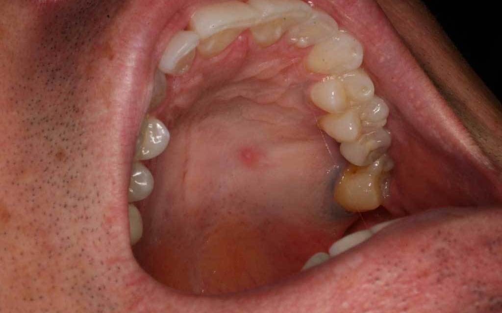 Why Is The Roof Of My Mouth Swollen